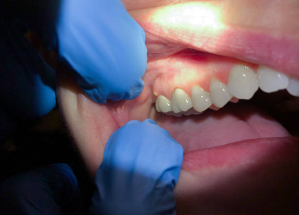 Best Emergency Wisdom Teeth Removal in Glen Burnie, MD
